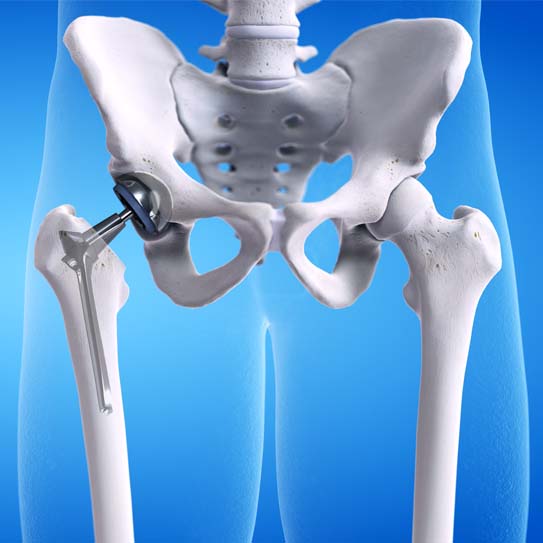 know-more-about-Hip Replacement-treatment-in-Pune